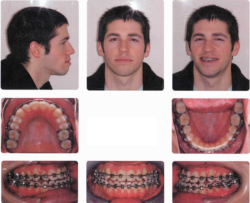 Orthognathic Surgery Jaw Wired Shut Diet